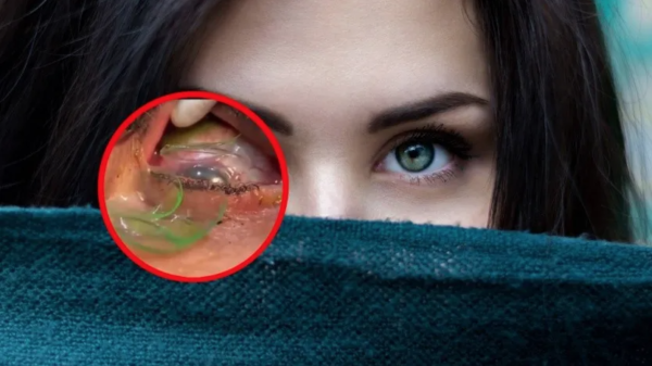 VIDEO: Mujer tenía enterrados más de 20 lentes de contacto y graban la forma en que se los retiraron