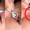 VIDEO: Mujer exhibe la forma en que le sacaron un gusano del ojo