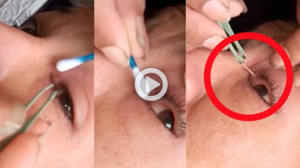 VIDEO: Mujer exhibe la forma en que le sacaron un gusano del ojo