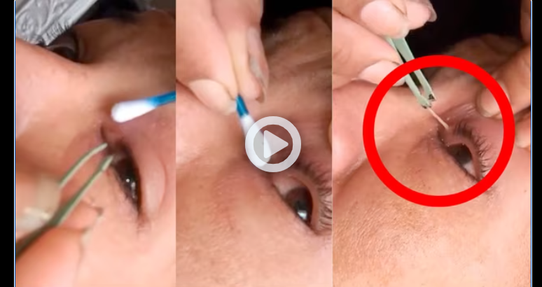 VIDEO: Mujer exhibe la forma en que le sacaron un gusano del ojo
