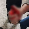 IMÁGENES FUERTES: Hombre termina con el dedo amputado tras accidente en la línea 3 del metro