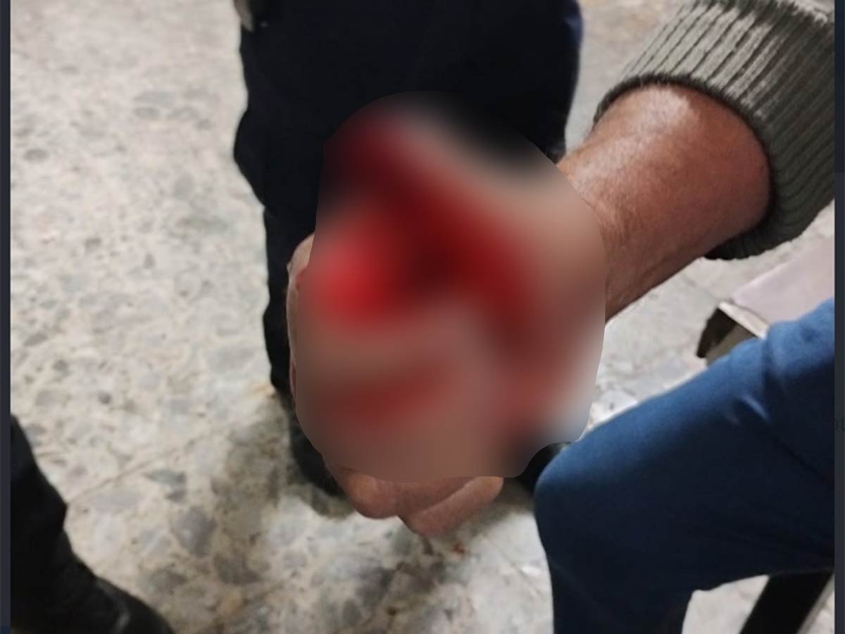 IMÁGENES FUERTES: Hombre termina con el dedo amputado tras accidente en la línea 3 del metro