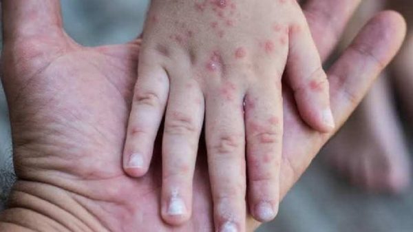 Emiten alerta sanitaria por el virus coxsackie en Hidalgo; ya hay 6 casos detectados