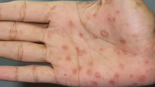 Se disparan los casos de sífilis; Jalisco y CDMX concentran la mayoría de contagios