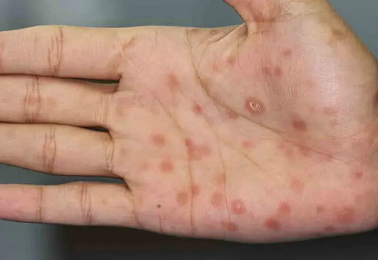 Se disparan los casos de sífilis; Jalisco y CDMX concentran la mayoría de contagios