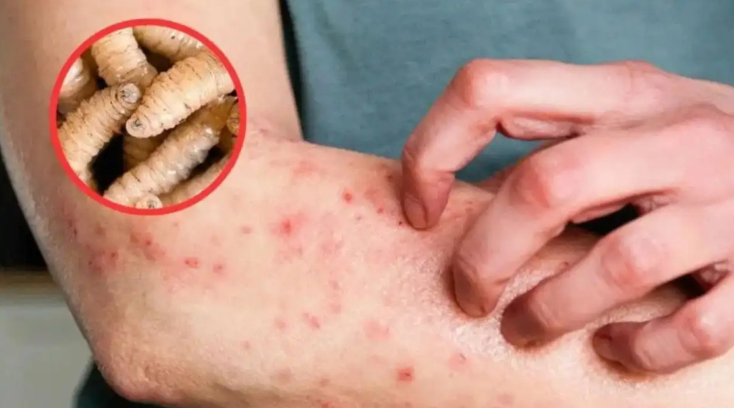 Yucatán reporta sexto caso de gusano barrenador en humanos este 2025