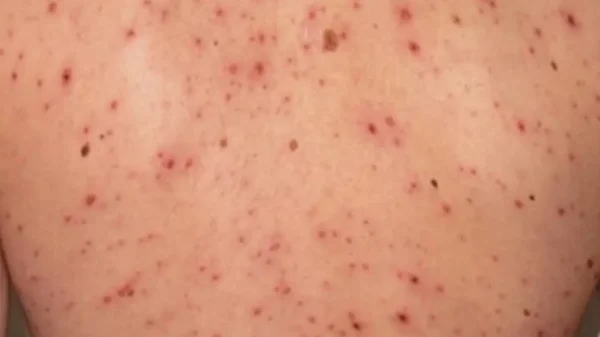 Se registra primera muerte por sarampión en 2026