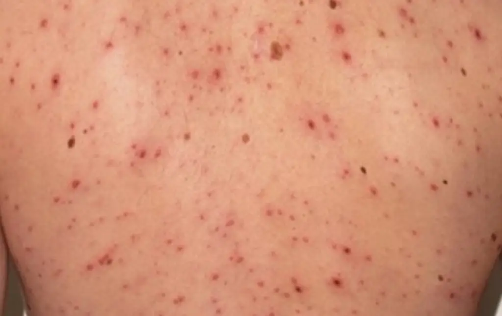 Se registra primera muerte por sarampión en 2026