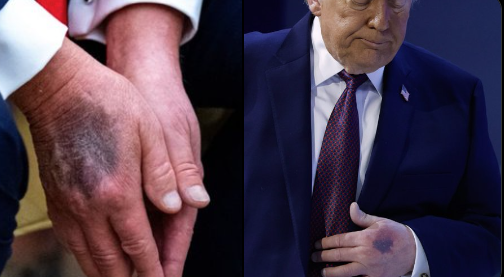 Trump vuelve a mostrar posibles problemas de salud en Davos