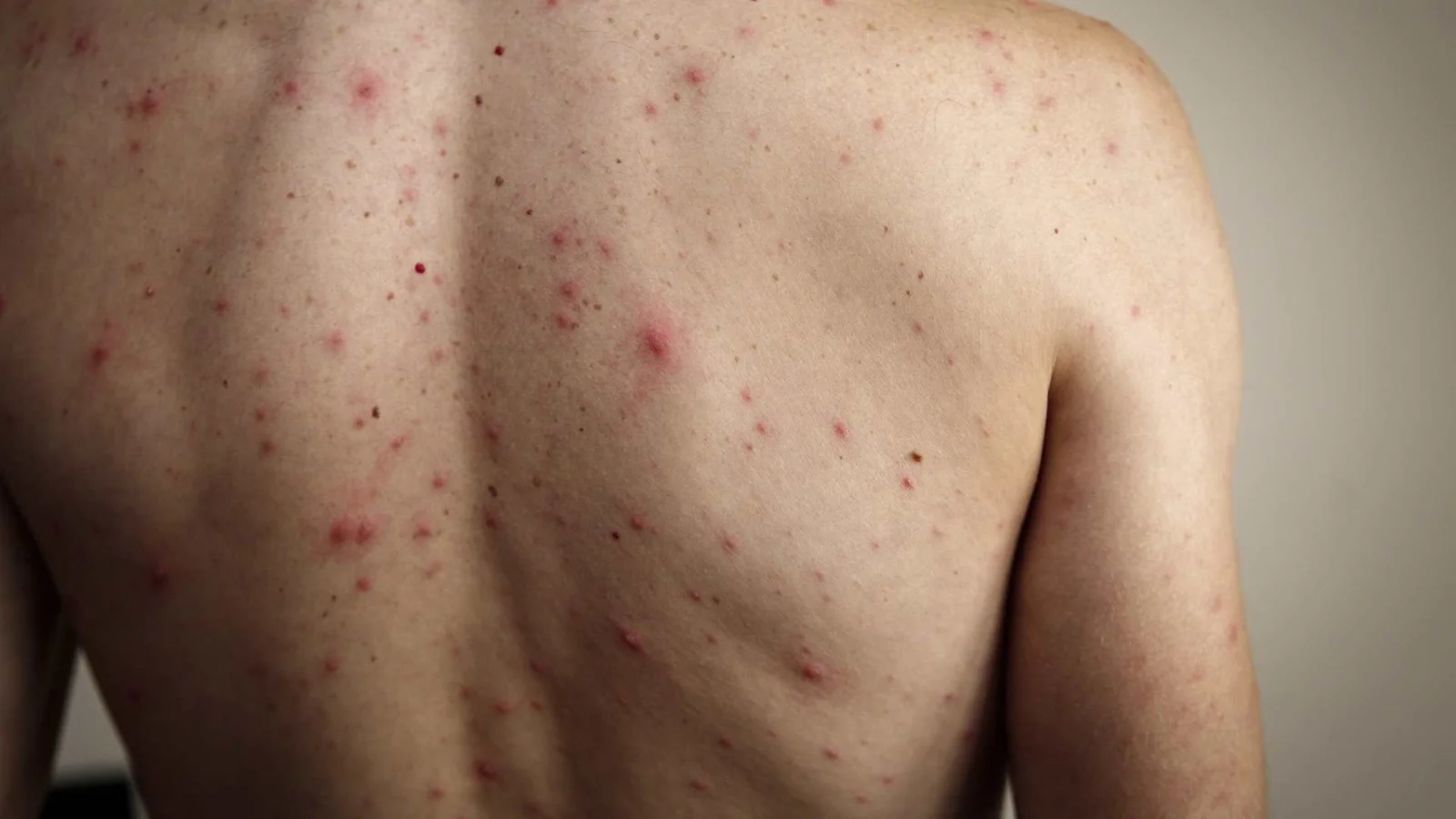 Sarampión en México: alertan por repunte previo al Mundial 2026