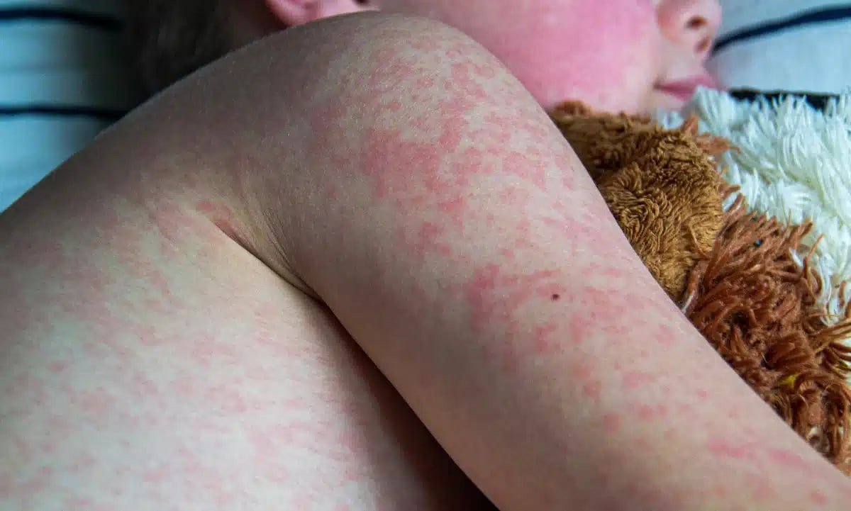 Confirman primera muerte por sarampión en Chiapas; México suma 29 decesos y más de 9 mil casos