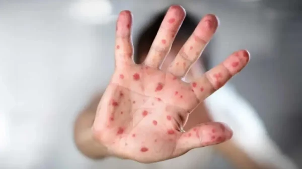 México supera los 13 mil 408 casos de sarampión y suman 35 muertes