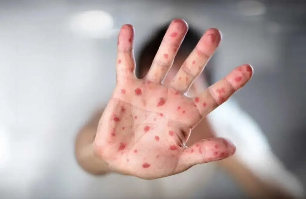 México supera los 13 mil 408 casos de sarampión y suman 35 muertes