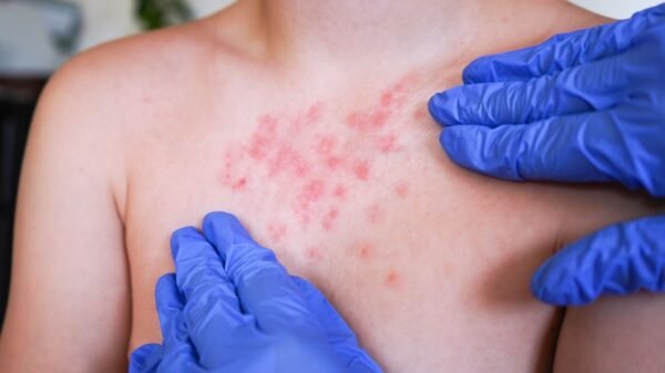 Se elevan a 14 mil 605 los casos de sarampión en México