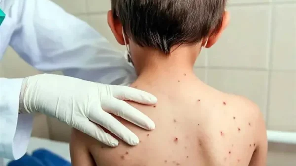 Con 139 nuevos casos, México acumula 18 mil 524 contagios y 43 muertes por sarampión