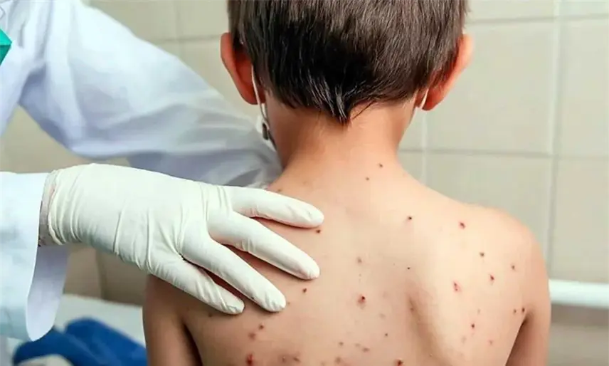 Con 139 nuevos casos, México acumula 18 mil 524 contagios y 43 muertes por sarampión